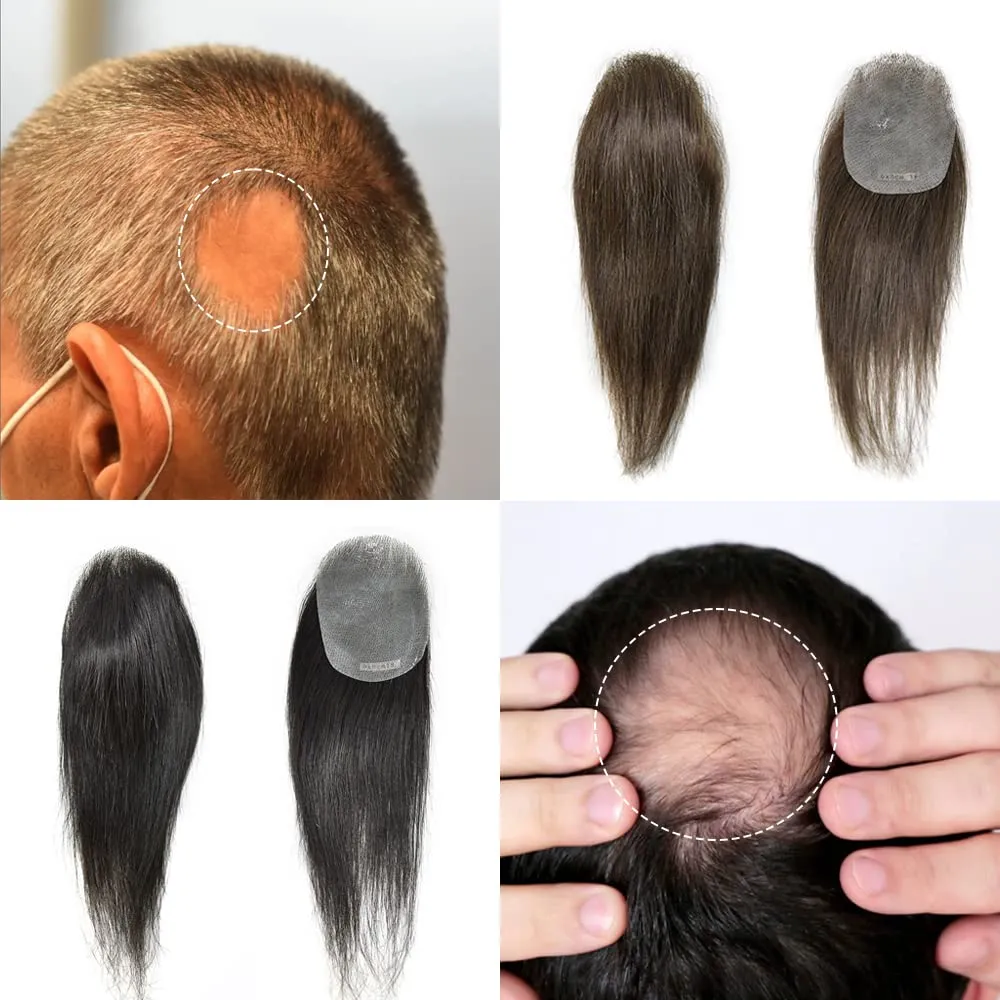 V-Looped Remy Human Hair Patch for Bald Spot - Natural Looking Replacement Unit With Thin Skin for Men (#3 Dark Brown, 4cm X 8cm - 6 Inch)
